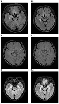 Epileptic Seizures and Right-Sided Hippocampal Swelling as Presenting Symptoms of Anti-IgLON5 Disease: A Case Report and Systematic Review of the Literature